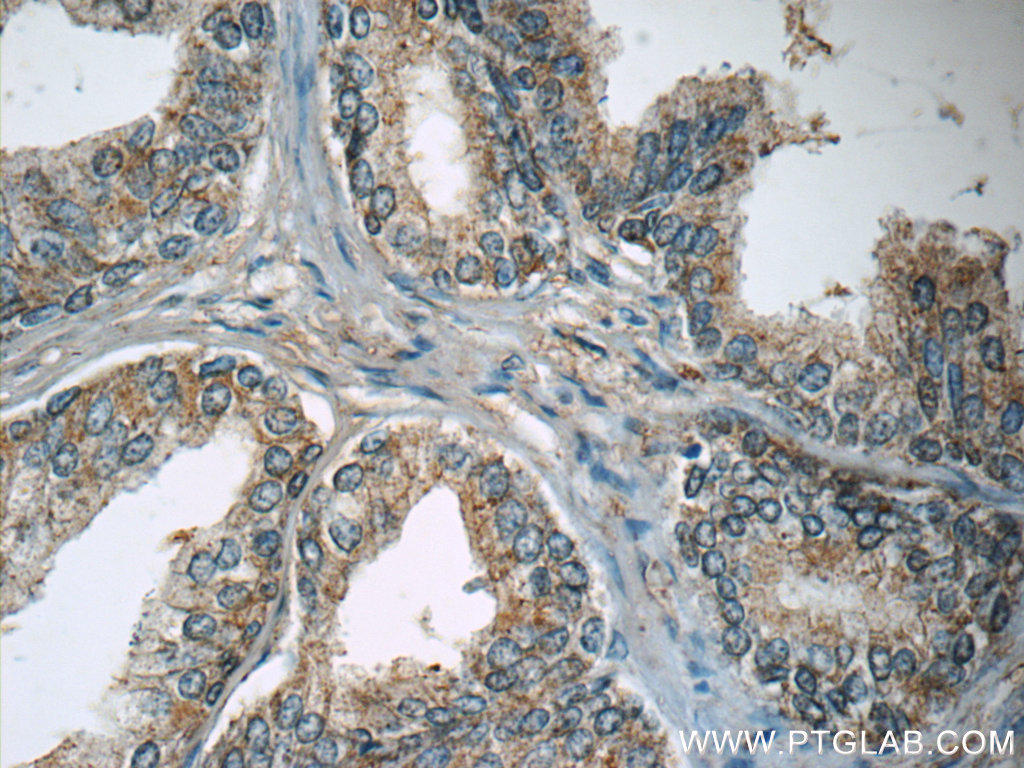IHC staining of human prostate hyperplasia using 13647-1-AP