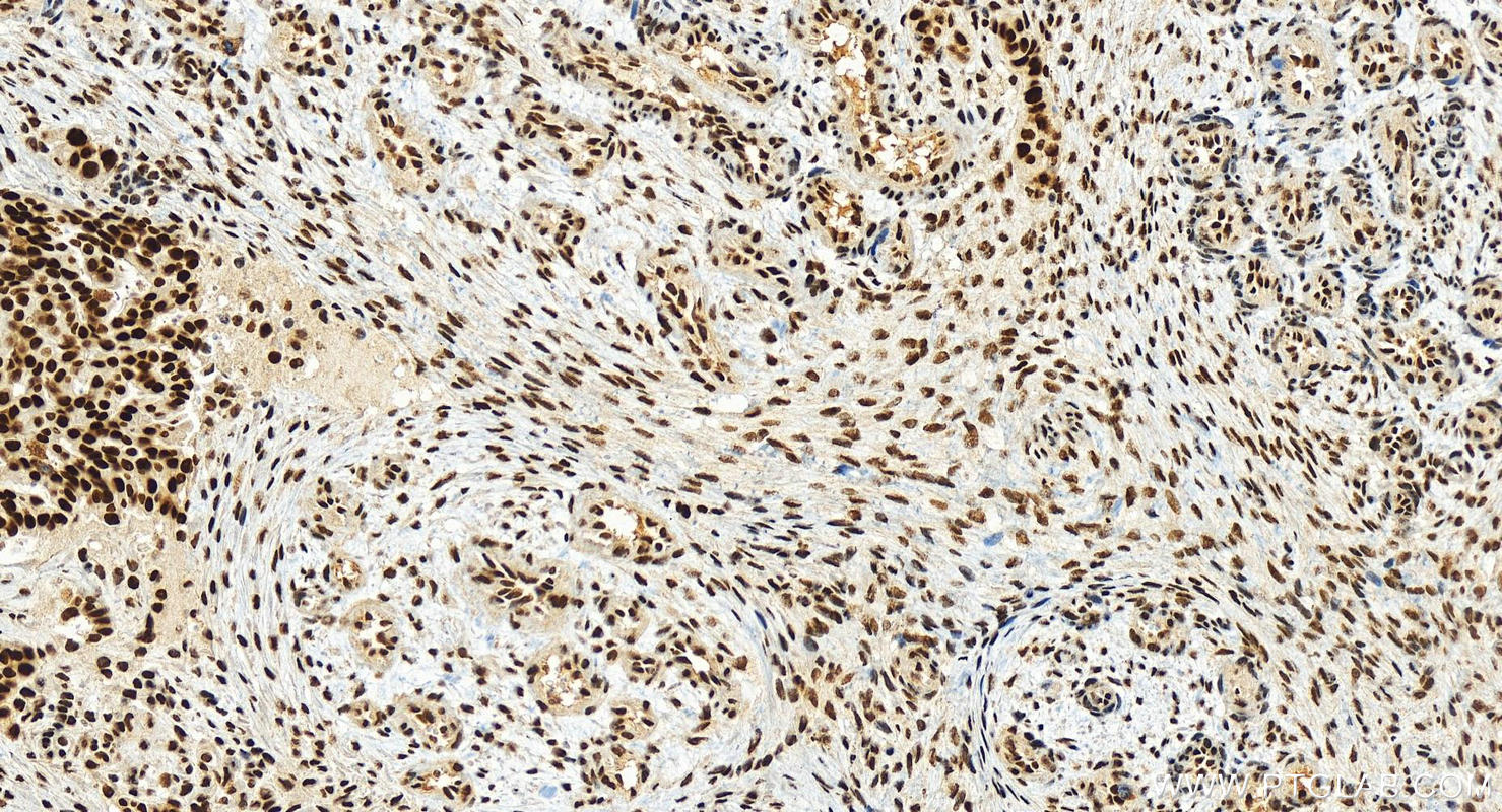 IHC staining of human ovarian  cancer using 22614-1-AP