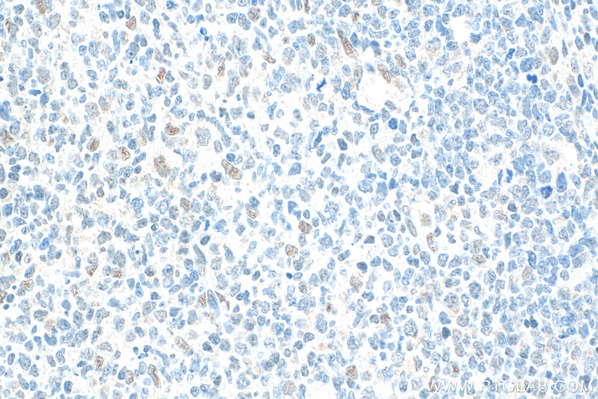 IHC staining of human tonsillitis using 15544-1-AP