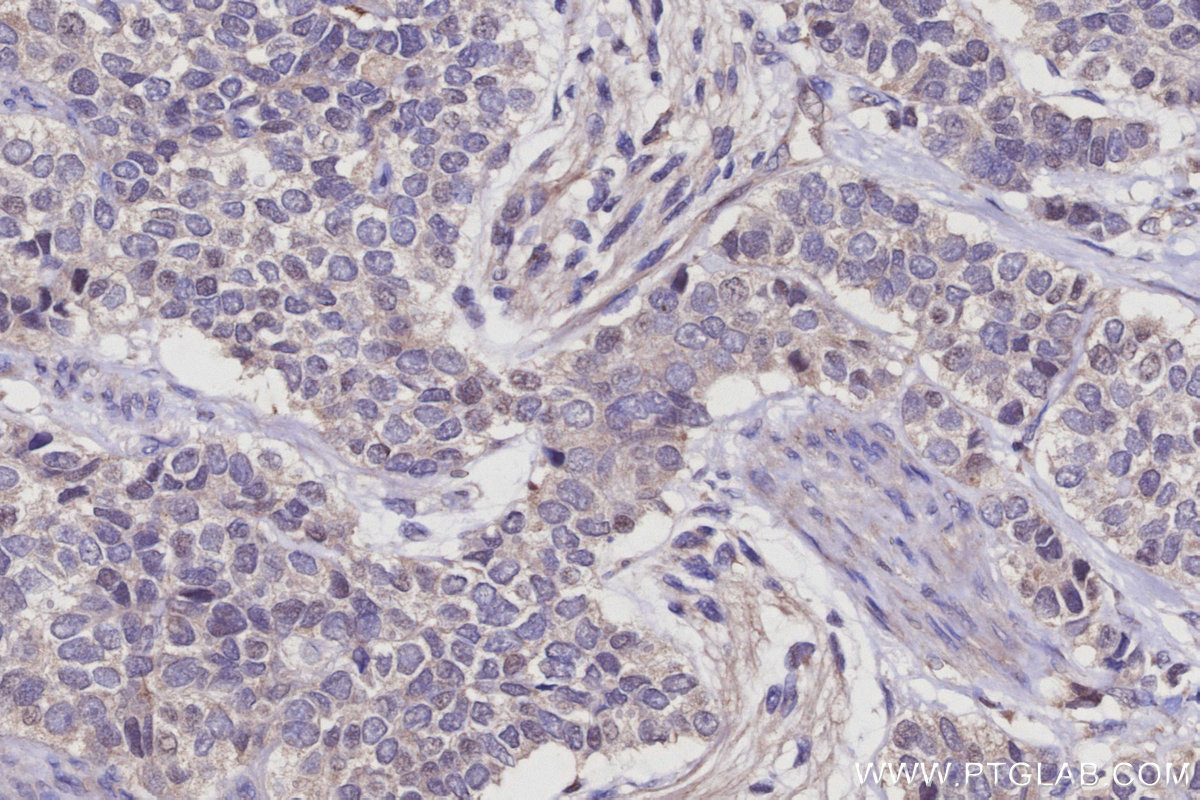 IHC staining of human stomach cancer using 20508-1-AP IHC staining of human stomach cancer using 20508-1-AP