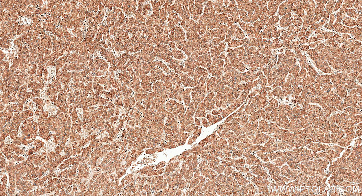 IHC staining of human liver cancer using 20508-1-AP IHC staining of human liver cancer using 20508-1-AP