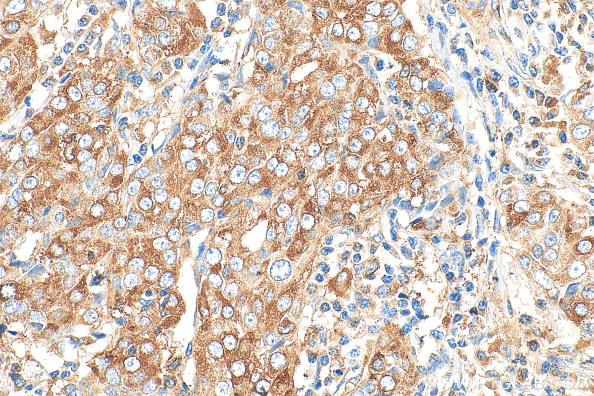 IHC staining of human ovary tumor using 33483-1-AP