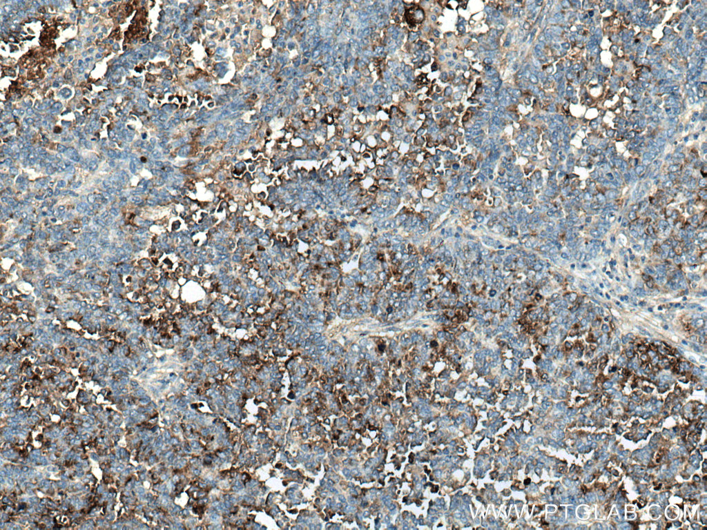 IHC staining of human ovary tumor using 14406-1-AP