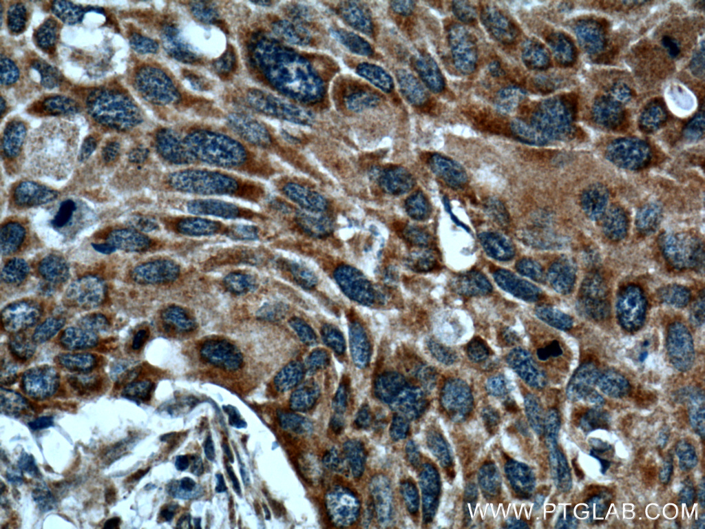 IHC staining of human oesophagus cancer using 26238-1-AP