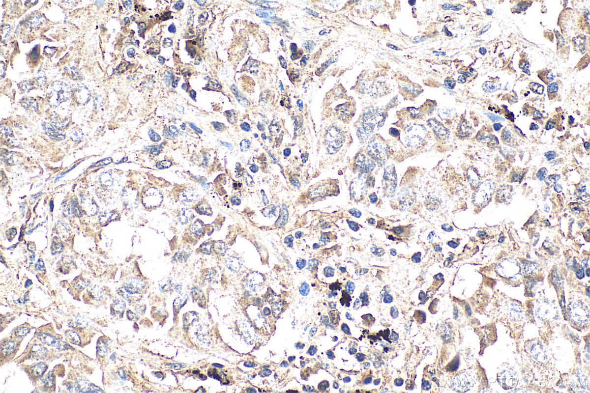 IHC staining of human lung cancer using 29793-1-AP
