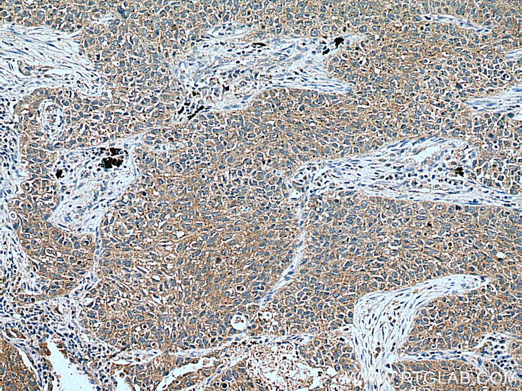 IHC staining of human lung cancer using 55184-1-AP