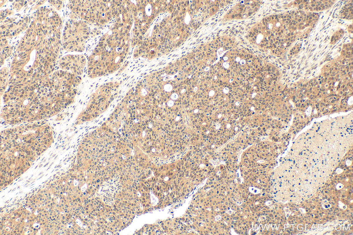 IHC staining of human ovary tumor using 14761-1-AP