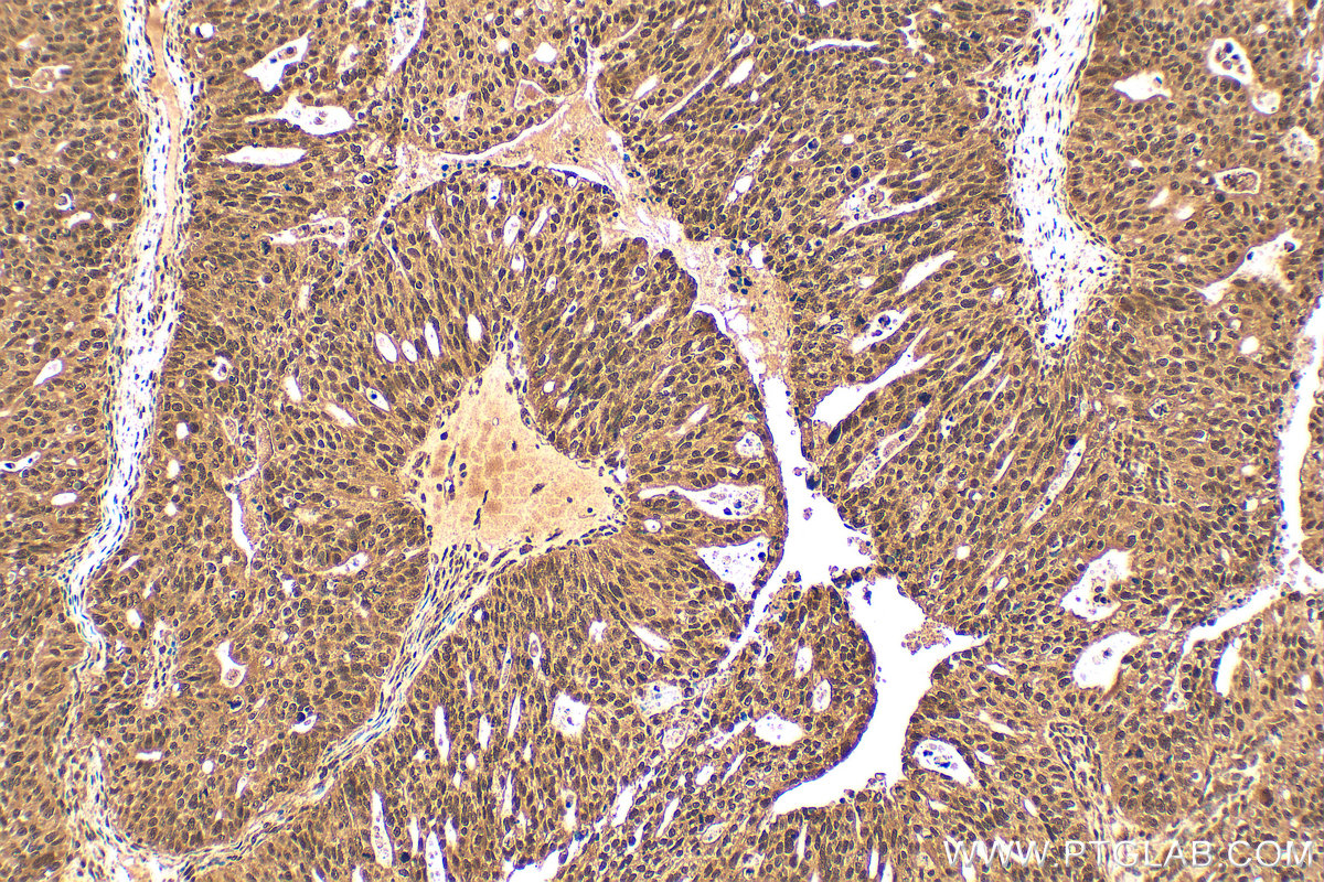IHC staining of human ovary tumor using RMX00057 IHC staining of human ovary tumor using RMX00057