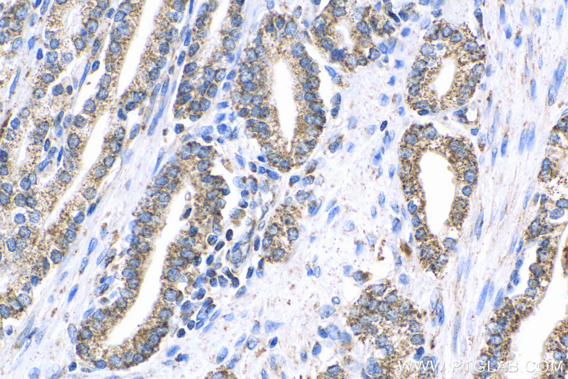 IHC staining of human prostate cancer using 11666-1-AP