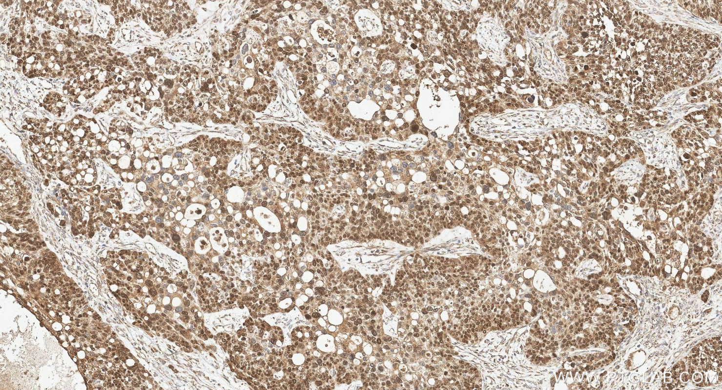 IHC staining of human ovary cancer using 12609-1-AP IHC staining of human ovary cancer using 12609-1-AP