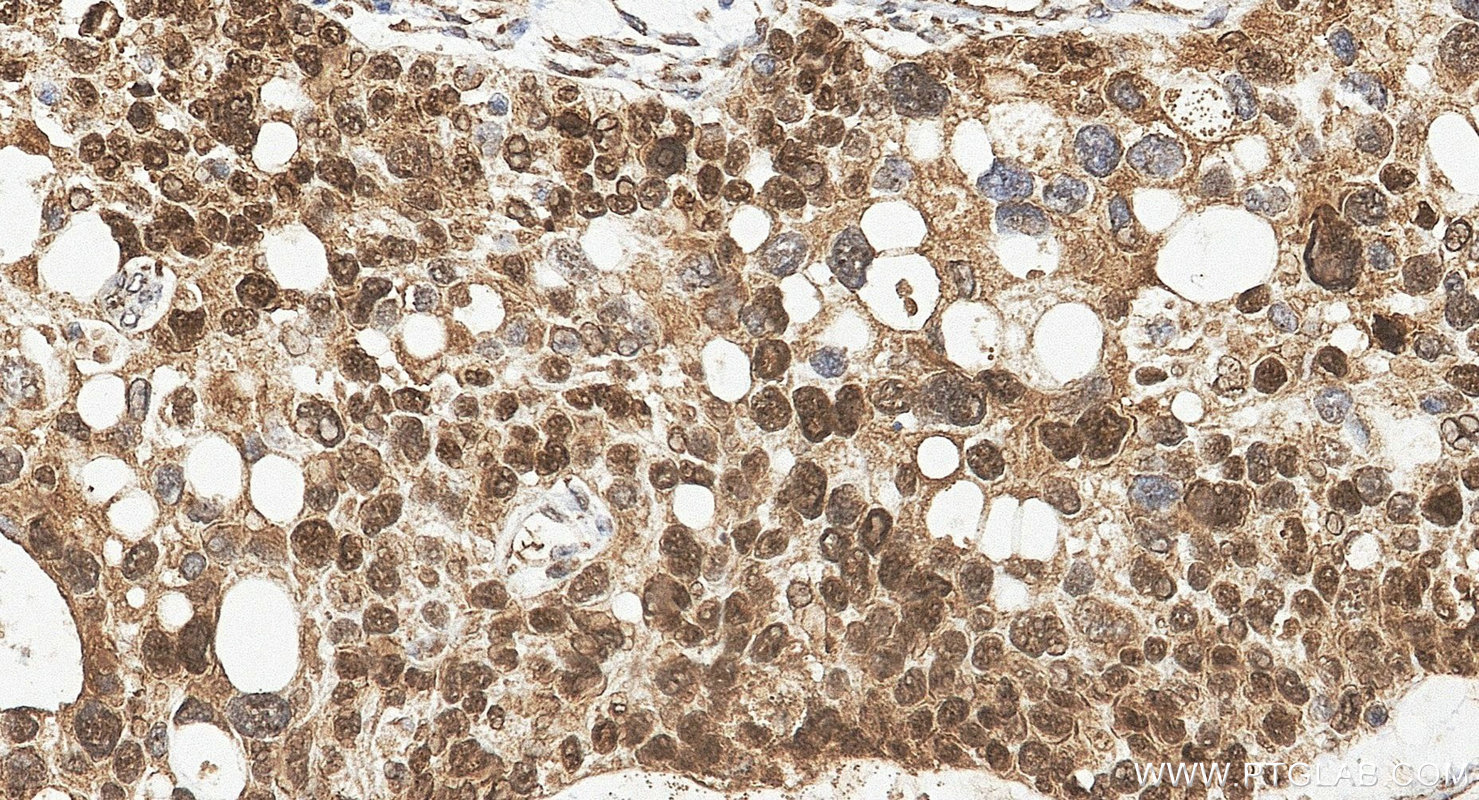 IHC staining of human ovary cancer using 12609-1-AP IHC staining of human ovary cancer using 12609-1-AP