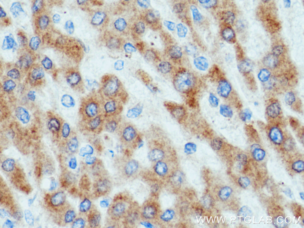 IHC staining of human liver cancer using 15299-1-AP