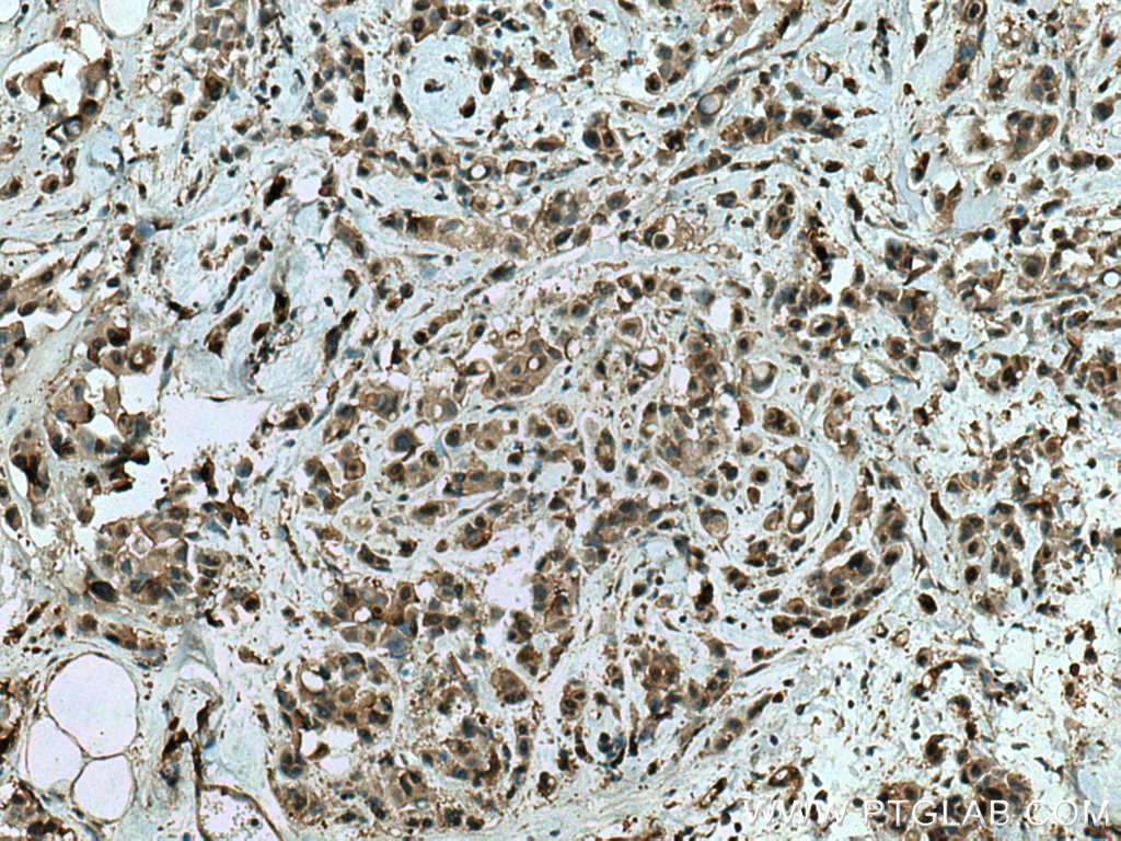 IHC staining of human breast cancer using 28689-1-AP (same clone as 28689-1-PBS)