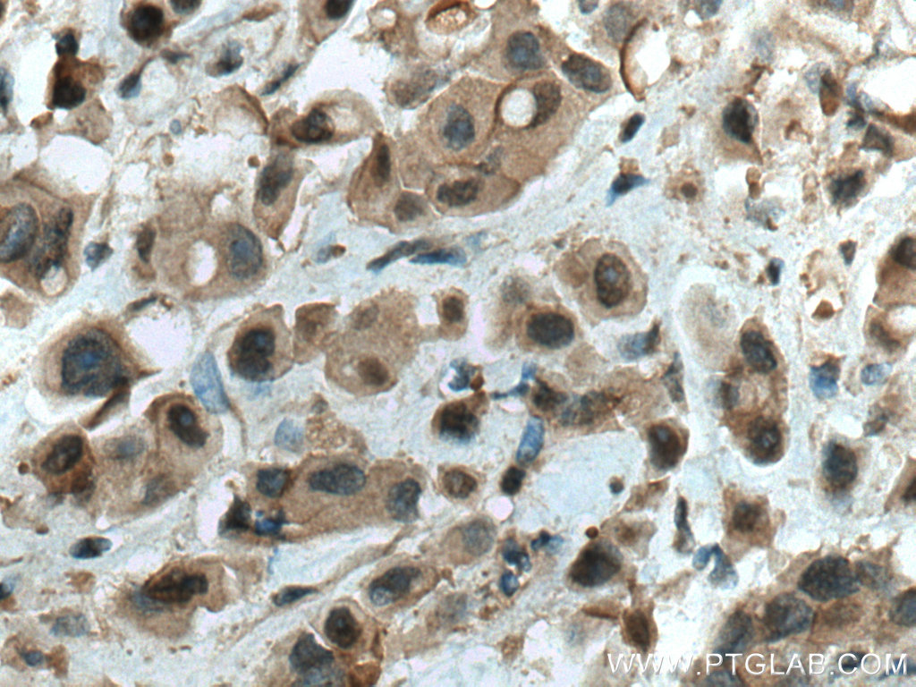 IHC staining of human breast cancer using 28689-1-AP (same clone as 28689-1-PBS)