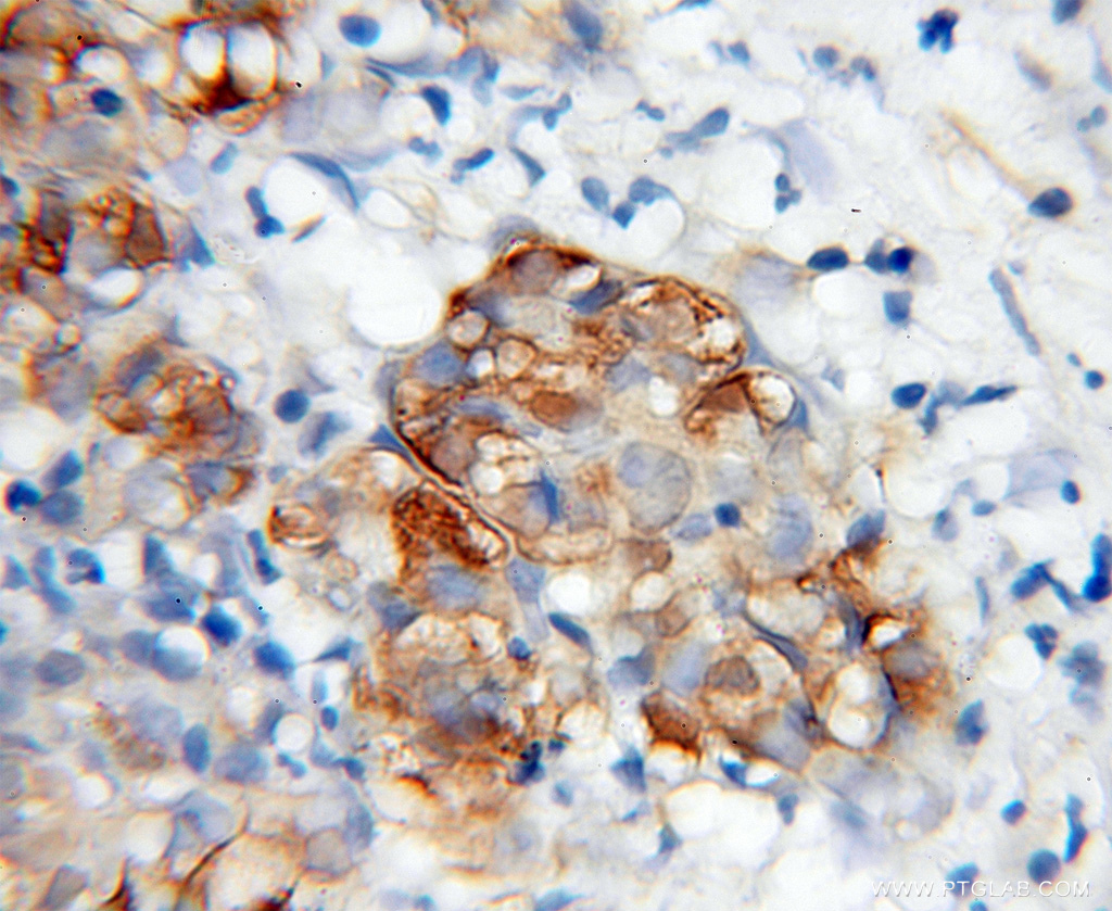 IHC staining of human pancreas cancer using 12197-1-AP