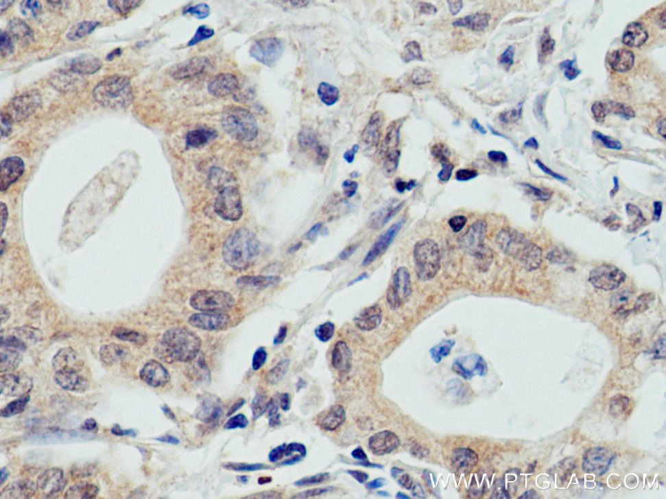 IHC staining of human pancreas cancer using 67274-1-Ig (same clone as 67274-1-PBS)