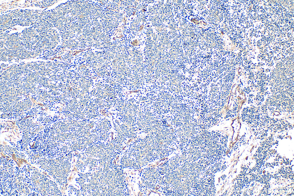 IHC staining of human lung cancer using 23306-1-AP