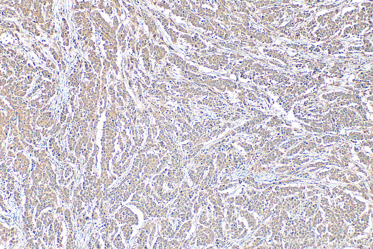 IHC staining of human colon cancer using 23306-1-AP