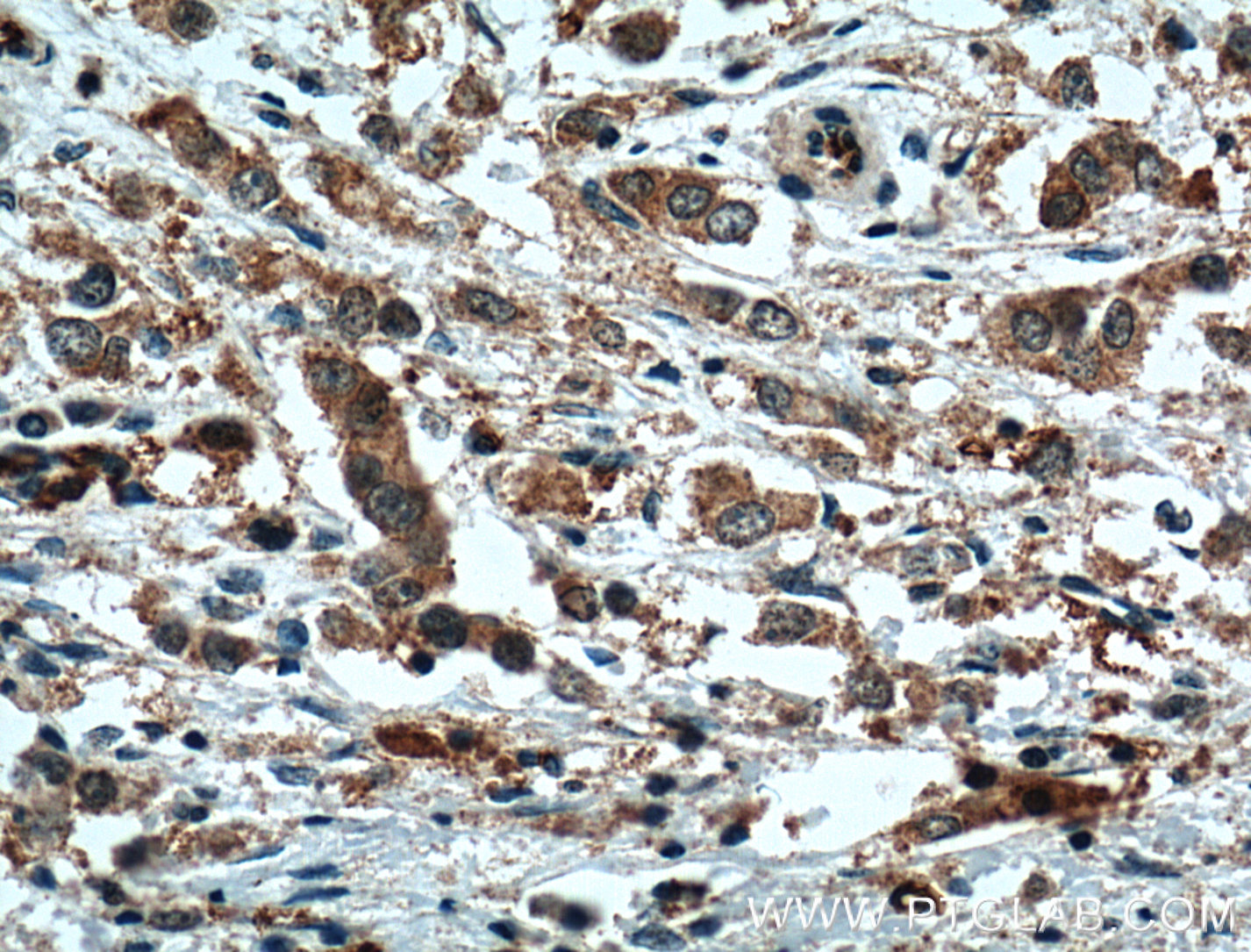 IHC staining of human breast cancer using 24168-1-AP