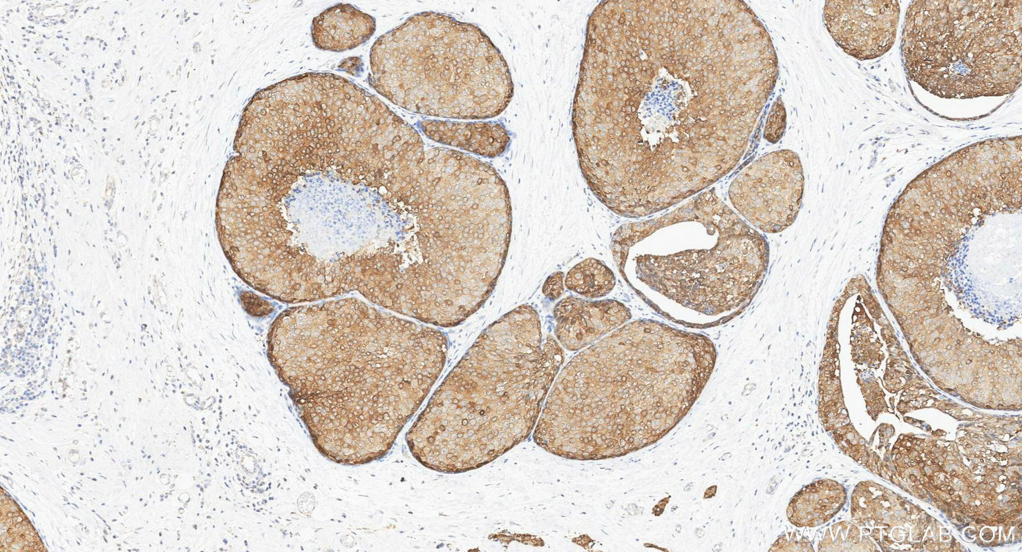 IHC staining of human breast cancer using 24868-1-AP IHC staining of human breast cancer using 24868-1-AP