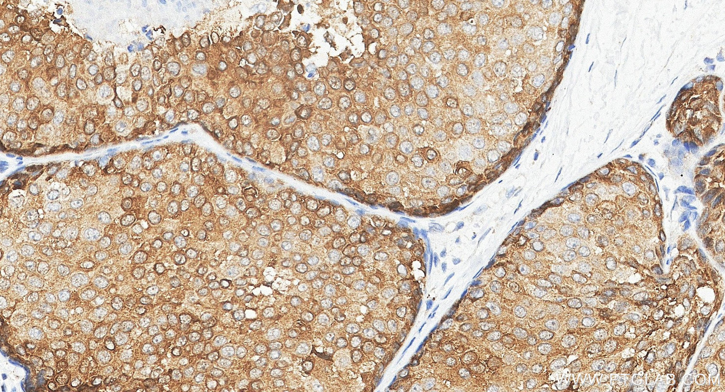 IHC staining of human breast cancer using 24868-1-AP IHC staining of human breast cancer using 24868-1-AP
