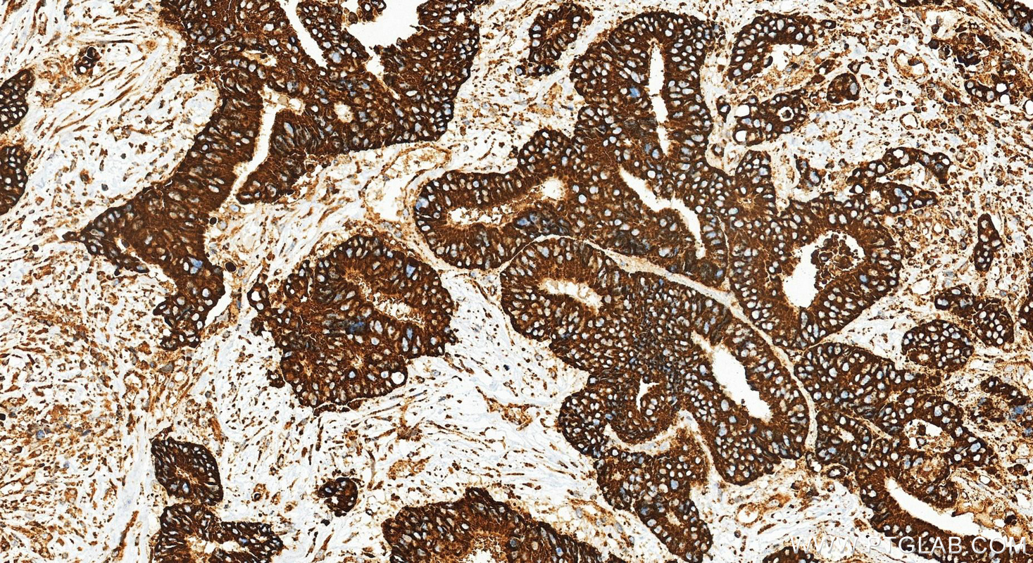 Immunohistochemical analysis of paraffin-embedded human colon cancer tissue slide using 83959-5-RR (XBP1S-specific antibody) at dilution of 1:1000 (under 20x lens). Heat mediated antigen retrieval with Tris-EDTA buffer (pH 9.0). IHC staining of human colon cancer using 83959-5-RR