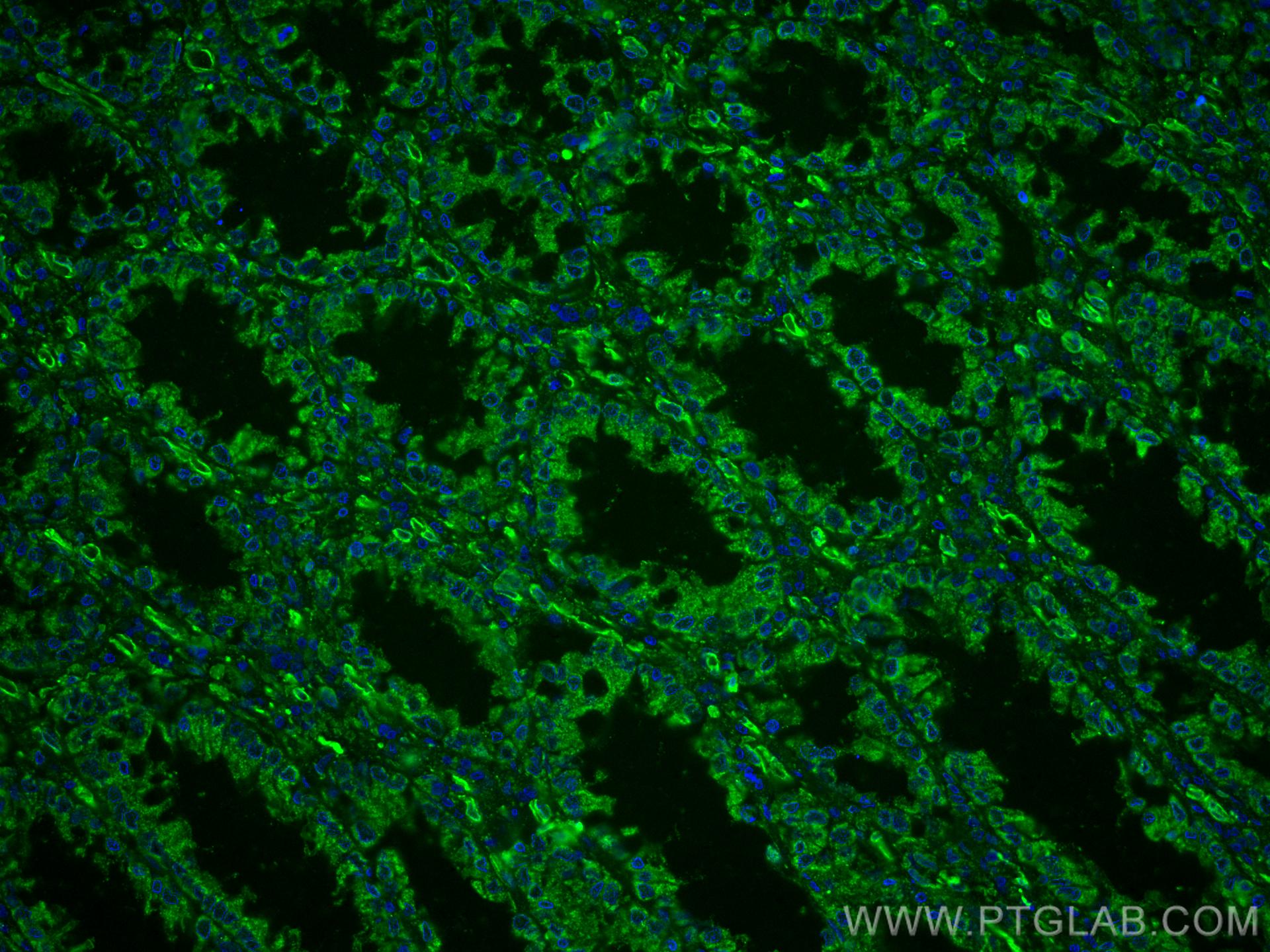 IF Staining of human colon cancer using CL488-66800