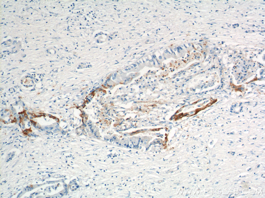 IHC staining of human pancreas cancer using 12830-1-AP