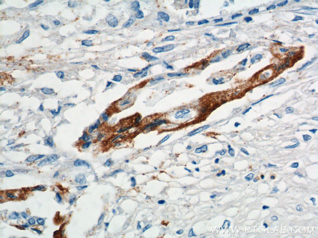 IHC staining of human pancreas cancer using 12830-1-AP