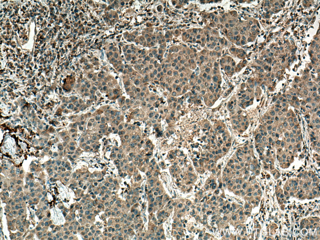 IHC staining of human breast cancer using 66763-1-Ig (same clone as 66763-1-PBS)