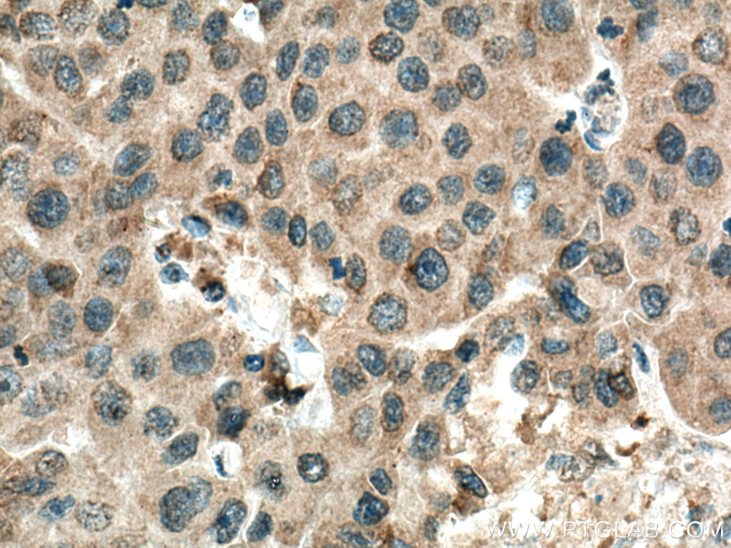IHC staining of human breast cancer using 66763-1-Ig (same clone as 66763-1-PBS)