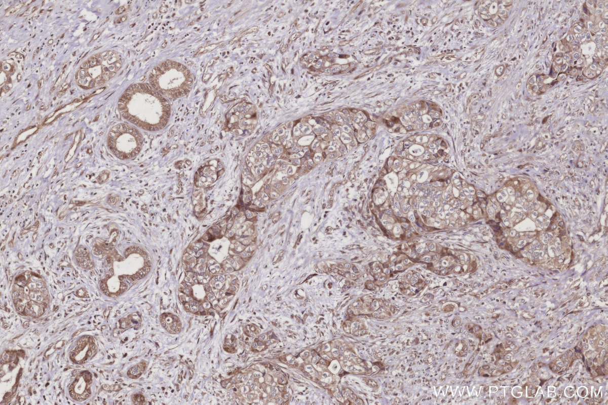 IHC staining of human pancreas cancer using 28628-1-AP IHC staining of human pancreas cancer using 28628-1-AP