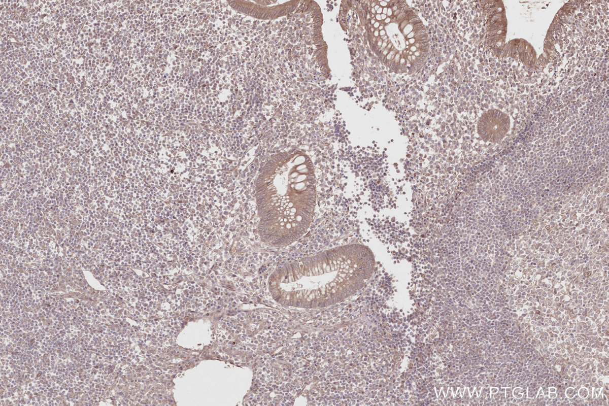 IHC staining of human appendicitis using 11408-1-AP IHC staining of human appendicitis using 11408-1-AP