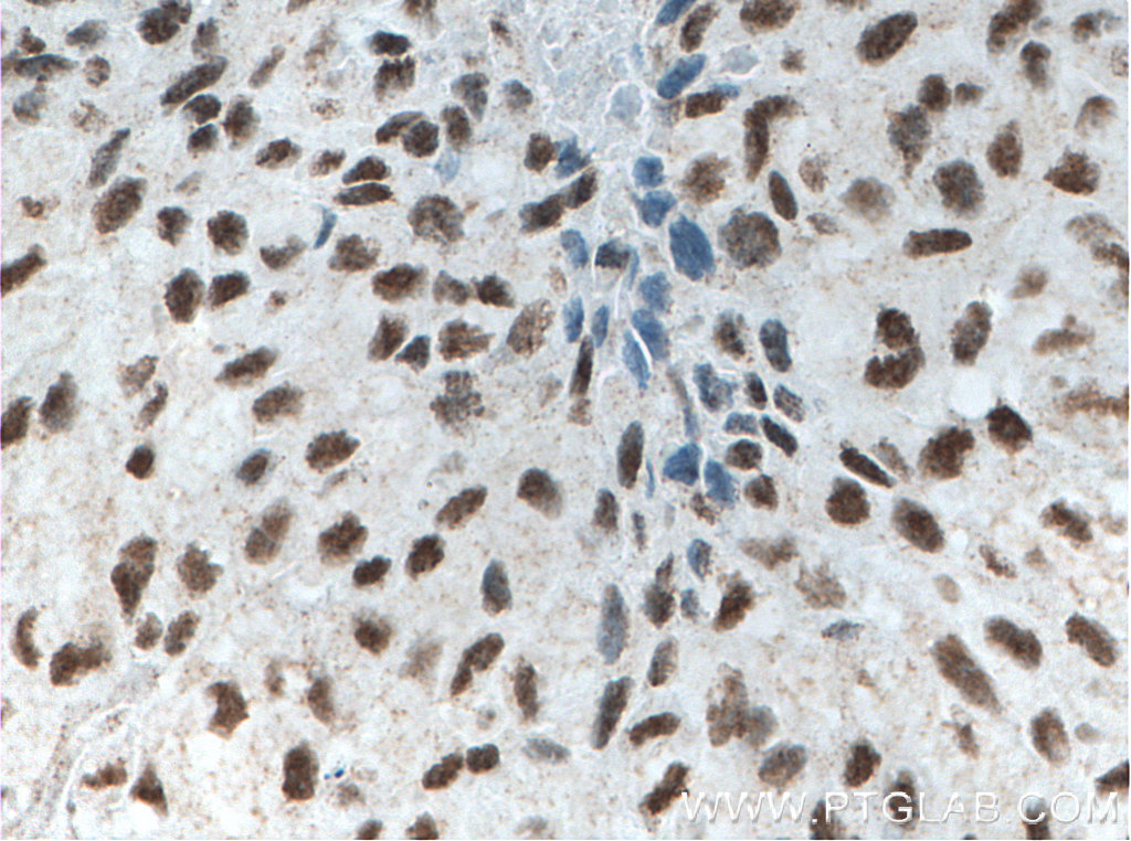 IHC staining of human lung cancer using 66546-1-Ig (same clone as 66546-1-PBS)