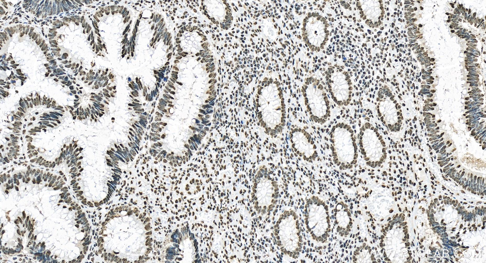 IHC staining of human colon cancer using 80325-6-RR