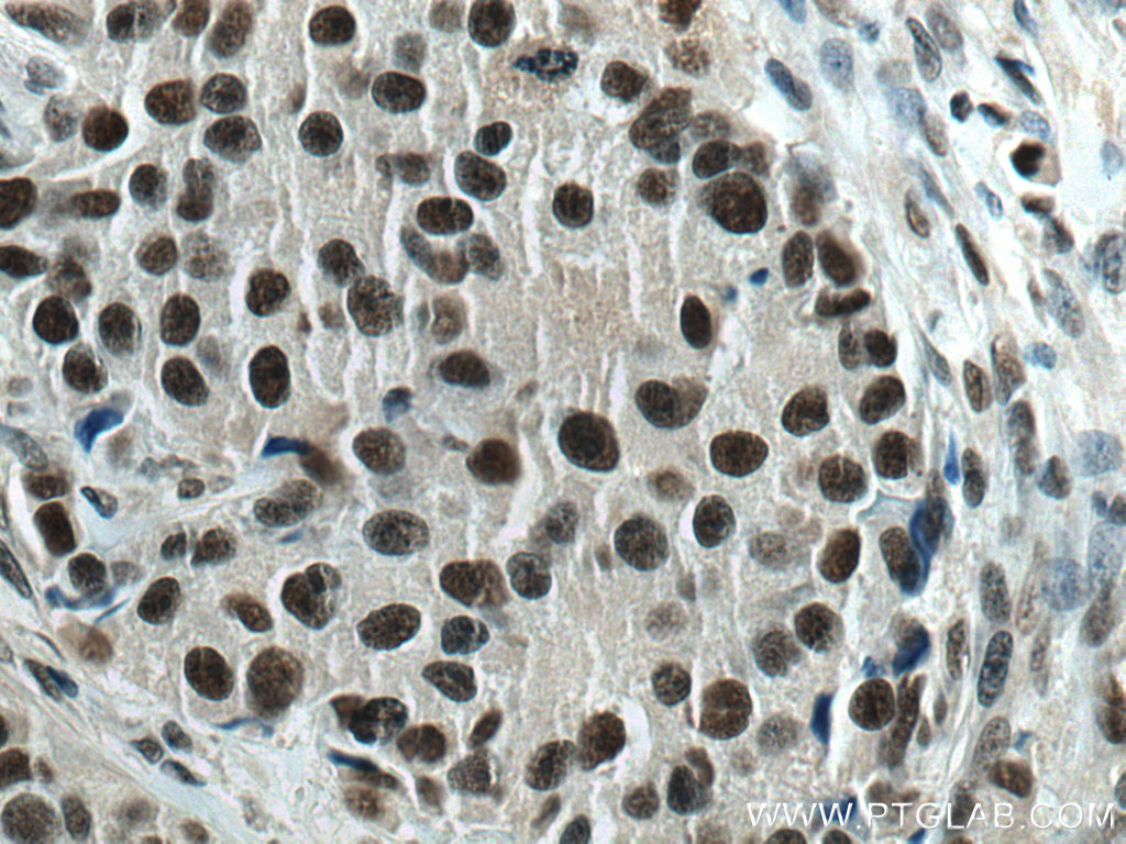 IHC staining of human breast cancer using 66852-1-Ig
