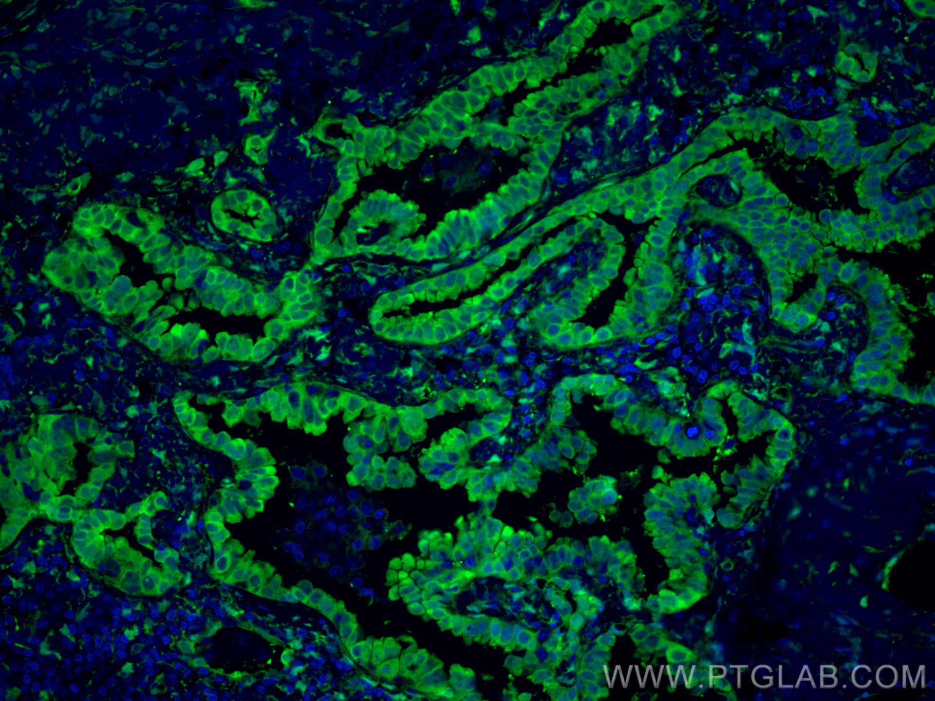 IF Staining of human lung cancer using 13584-1-AP