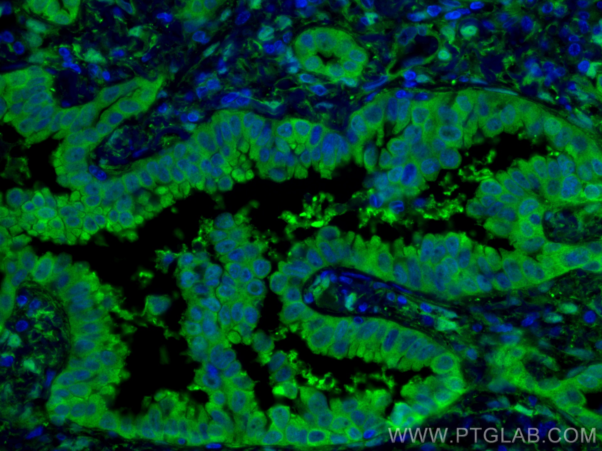 IF Staining of human lung cancer using 13584-1-AP