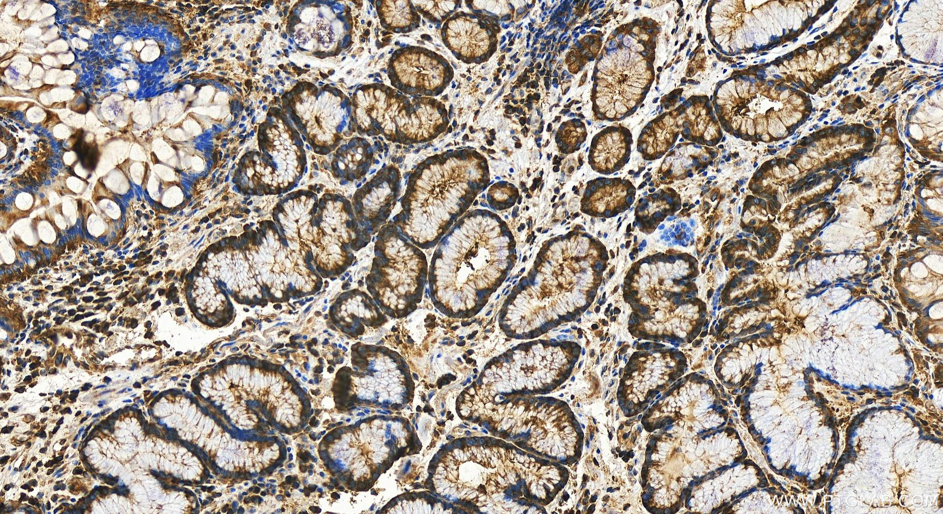 IHC staining of human stomach cancer using 31228-1-AP