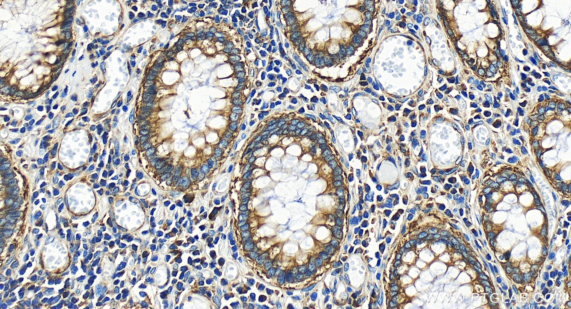 IHC staining of human colon cancer using 84993-4-RR (same clone as 84993-4-PBS)