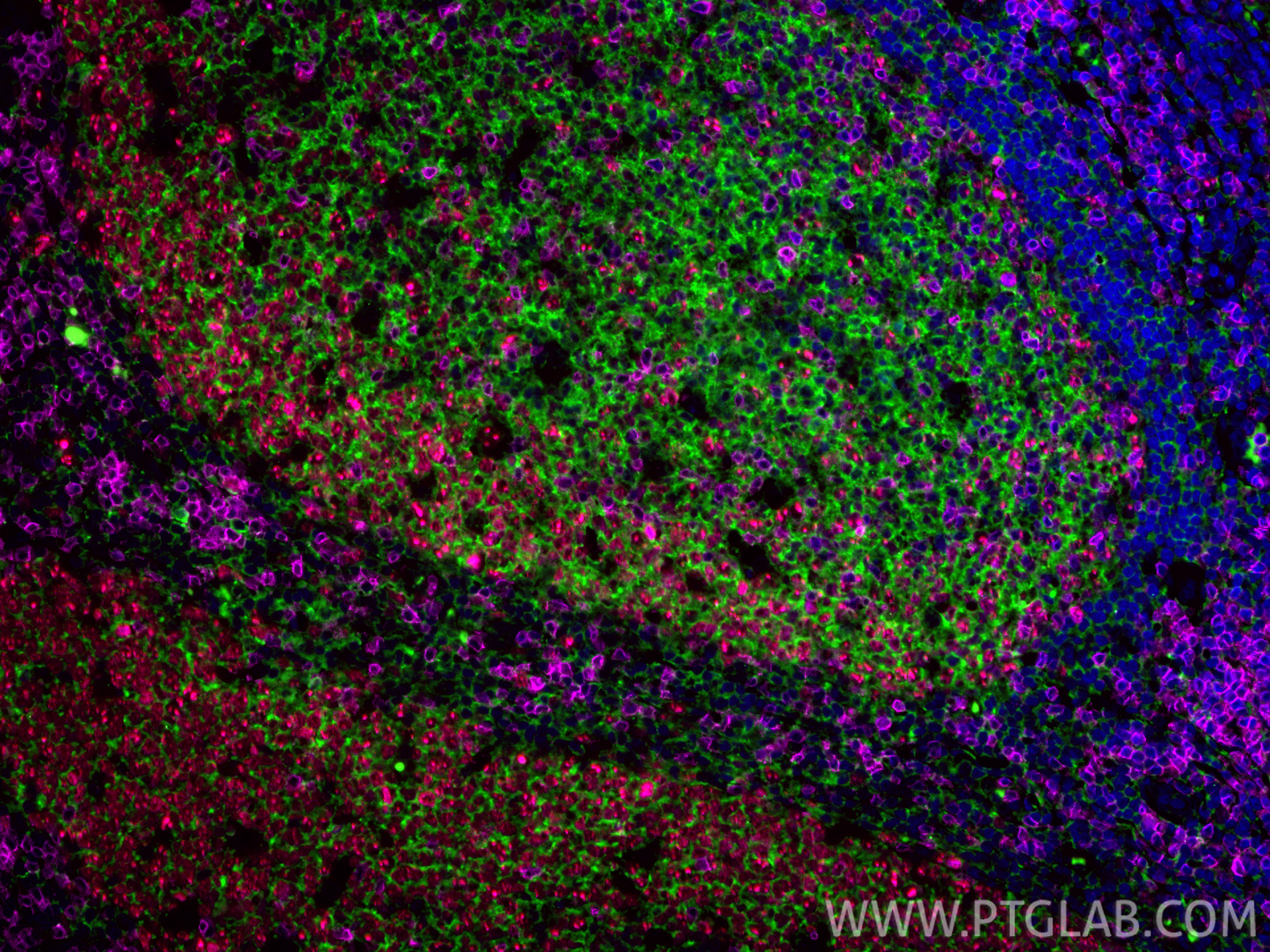 Immunofluorescent analysis of (4% PFA) fixed paraffin-embedded human tonsillitis tissue using CoraLite® Plus 488 CD20 antibody (CL488-60271, Clone: 4A7G3 ) at dilution of 1:200, CoraLite®594 Ki-67 antibody (CL594-84192-4, Clone: 241499E7, red), CoraLite® Plus 647 CD3 antibody (<a class='green' href='/productredirect?CatalogNo=CL647-17617' target='_blank'>CL647-17617</a>, Magenta). Heat mediated antigen retrieval with Tris-EDTA buffer (pH 9.0). IF Staining of human tonsillitis using CL488-60271