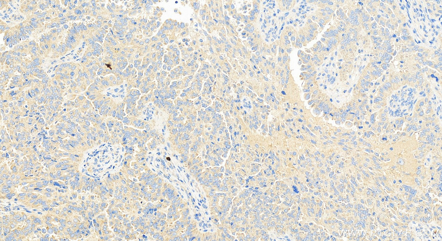 IHC staining of human ovary cancer using 12931-1-AP