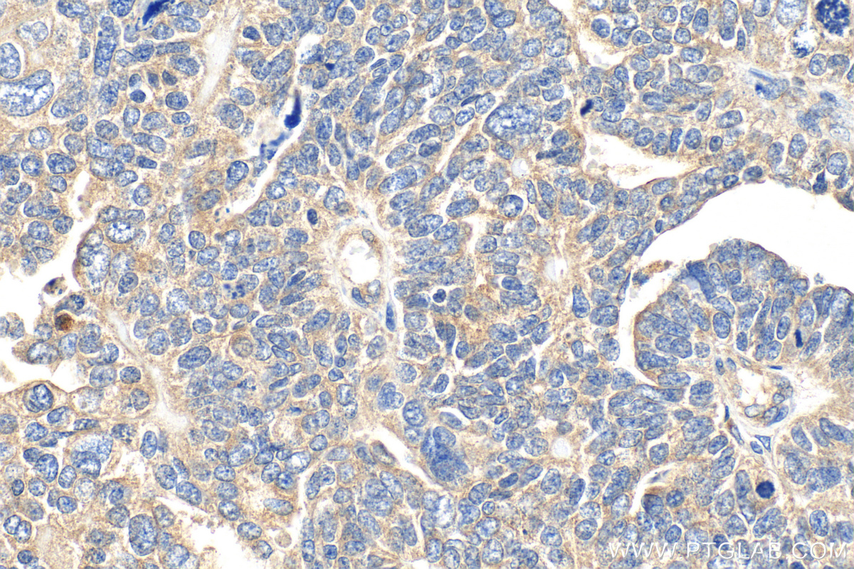 IHC staining of human ovary tumor using 33685-1-AP