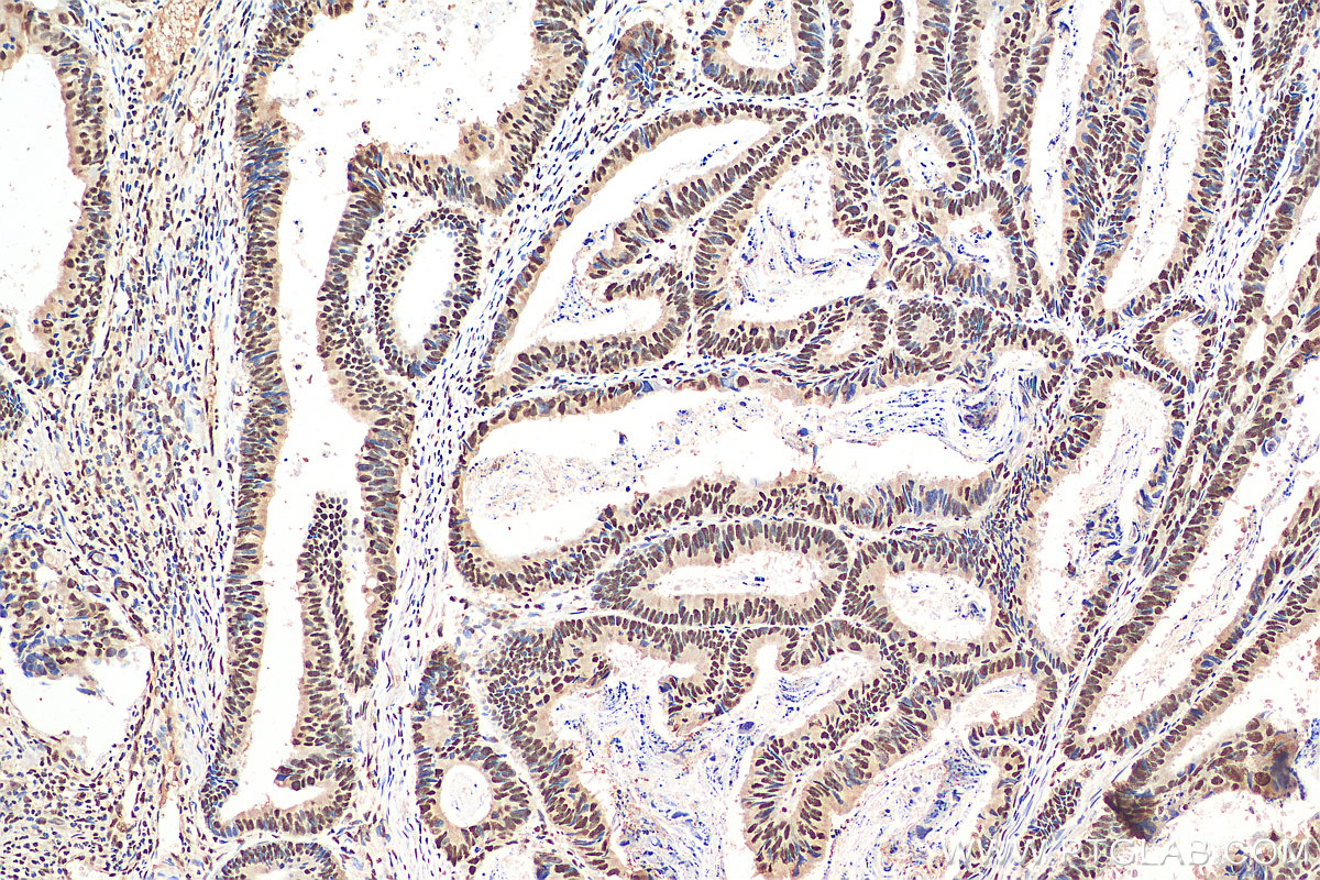 IHC staining of human colon cancer using 29441-1-AP