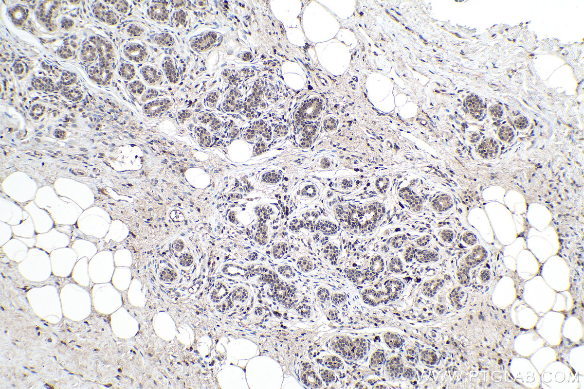 IHC staining of human breast cancer using 67911-1-Ig