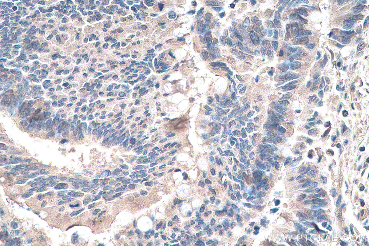 IHC staining of human colon cancer using 66745-1-Ig (same clone as 66745-1-PBS)