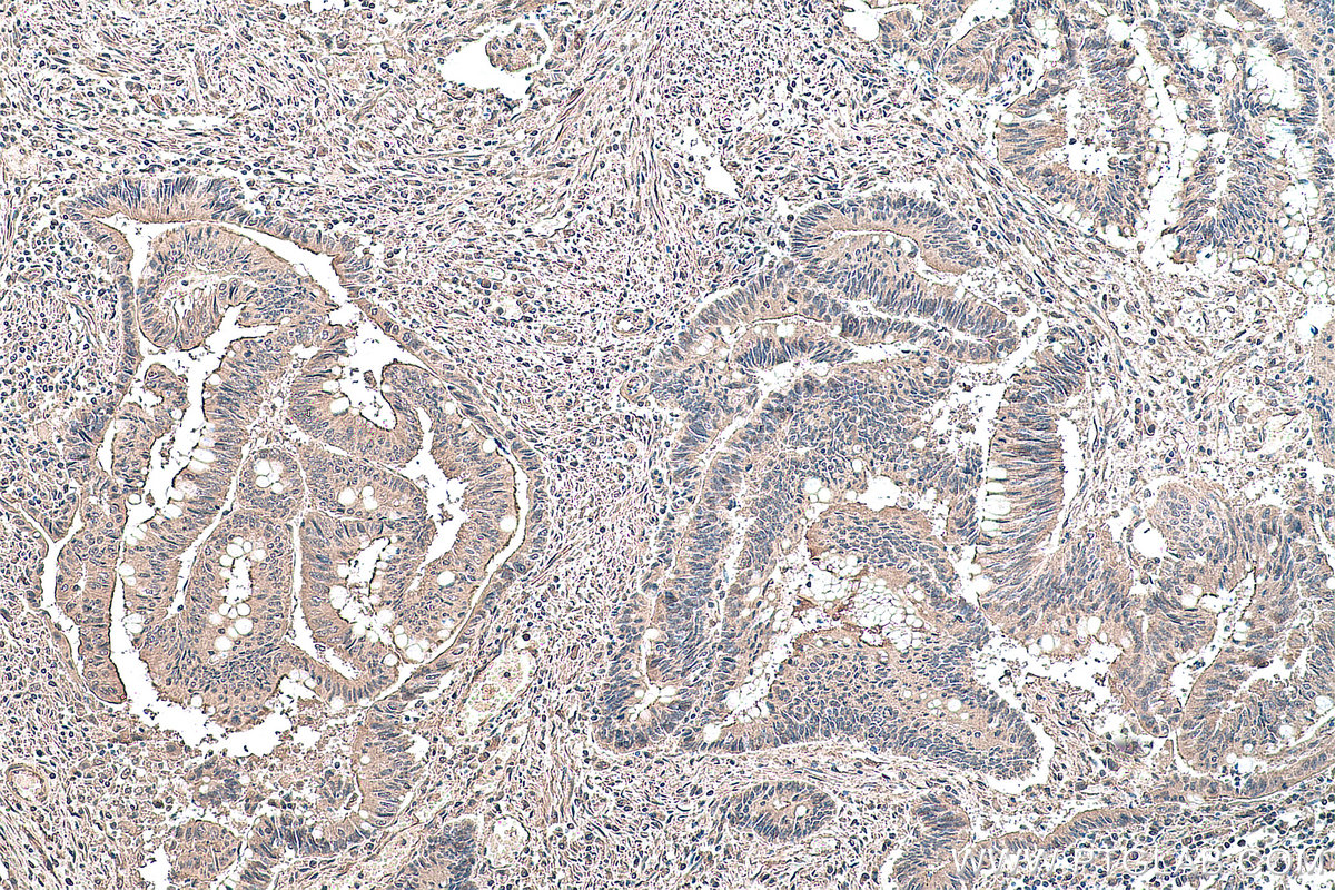 IHC staining of human colon cancer using 66745-1-Ig (same clone as 66745-1-PBS)