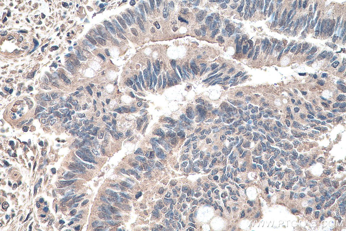 IHC staining of human colon cancer using 66745-1-Ig (same clone as 66745-1-PBS)