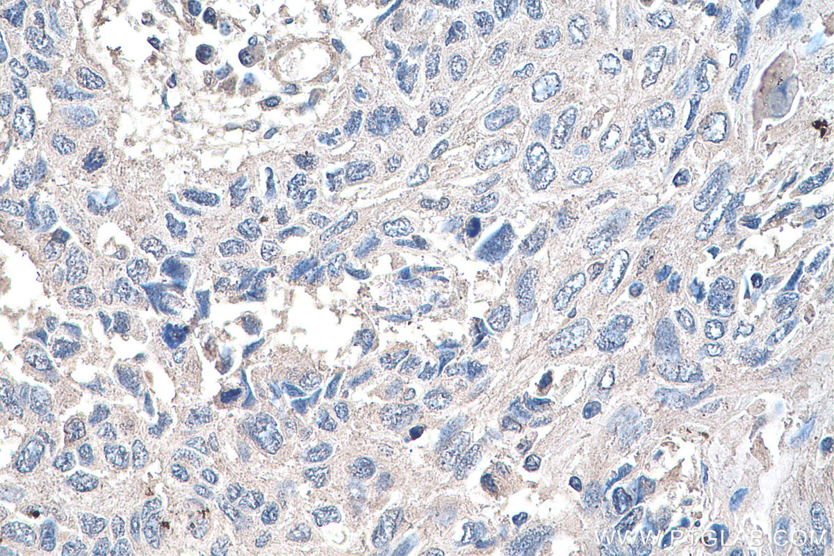 IHC staining of human lung cancer using 66745-1-Ig