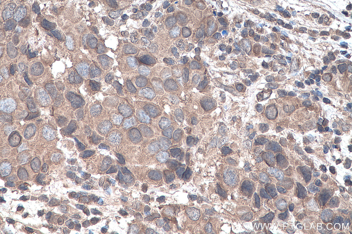 IHC staining of human breast cancer using 66745-1-Ig (same clone as 66745-1-PBS)